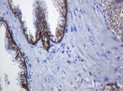 Immunohistochemistry: pan Cadherin Antibody (4F1) [NBP2-46200] - Analysis of Carcinoma of Human prostate tissue. (Heat-induced epitope retrieval by 10mM citric buffer, pH6.0, 120C for 3min)