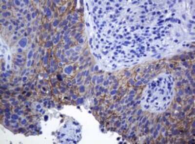 Immunohistochemistry: pan Cadherin Antibody (4F1) [NBP2-46200] - Analysis of Carcinoma of Human lung tissue. (Heat-induced epitope retrieval by 10mM citric buffer, pH6.0, 120C for 3min)