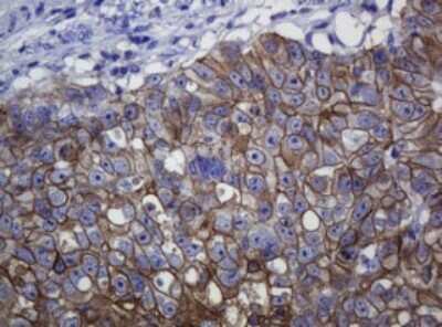 Immunohistochemistry: pan Cadherin Antibody (4F1) [NBP2-46200] - Analysis of Adenocarcinoma of Human colon tissue. (Heat-induced epitope retrieval by 10mM citric buffer, pH6.0, 120C for 3min)