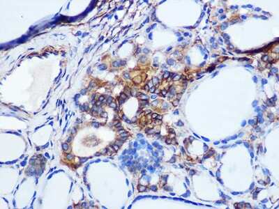 Immunohistochemistry-Paraffin: pan Cadherin Antibody (6N5P8) [NBP3-16509] - Immunohistochemistry of paraffin-embedded human thyroid cancer using pan Cadherin Rabbit mAb (NBP3-16509) at dilution of 1:100 (40x lens).Perform microwave antigen retrieval with 10 mM PBS buffer pH 7.2 before commencing with IHC staining protocol.