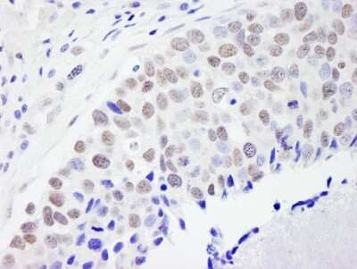 Immunohistochemistry: pre-mRNA cleavage factor I (59 kDa subunit) Antibody [NB100-61600] - Sample: FFPE section of human breast carcinoma. Antibody: Affinity purified rabbit anti-CPSF59 used at a dilution of 1:500 (2ug/ml). Detection: DAB