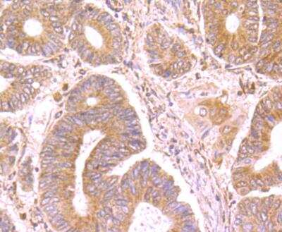 Immunohistochemistry-Paraffin: sFRP-1 Antibody [NBP2-89148] - Analysis of paraffin-embedded human colon cancer tissue using anti-SFRP1 antibody. Counter stained with hematoxylin.