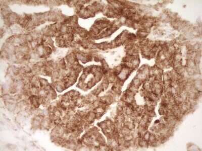 Immunohistochemistry: sFRP-2 Antibody (OTI6C2) - Azide and BSA Free [NBP2-74151] - Analysis of Adenocarcinoma of Human ovary tissue. (Heat-induced epitope retrieval by 1 mM EDTA in 10mM Tris, pH8.5, 120C for 3min)