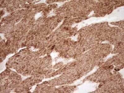 Immunohistochemistry: sFRP-2 Antibody (OTI6C2) - Azide and BSA Free [NBP2-74151] - Analysis of Carcinoma of Human lung tissue. (Heat-induced epitope retrieval by 1 mM EDTA in 10mM Tris, pH8.5, 120C for 3min)