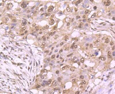 Immunohistochemistry-Paraffin: t-Plasminogen Activator/tPA Antibody (AH54-10) [NBP2-67279] - Analysis of paraffin-embedded human lung cancer tissue using anti-TPA antibody. Counter stained with hematoxylin.