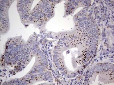 Immunohistochemistry: u-Plasminogen Activator/Urokinase Antibody (OTI5H4) - Azide and BSA Free [NBP2-74793] - Analysis of Adenocarcinoma of Human colon tissue. (Heat-induced epitope retrieval by 1 mM EDTA in 10mM Tris, pH8.5, 120C for 3min)