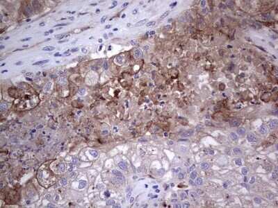 Immunohistochemistry: u-Plasminogen Activator/Urokinase Antibody (OTI5H4) - Azide and BSA Free [NBP2-74793] - Analysis of Carcinoma of Human lung tissue.(Heat-induced epitope retrieval by 1 mM EDTA in 10mM Tris, pH8.5, 120C for 3min)