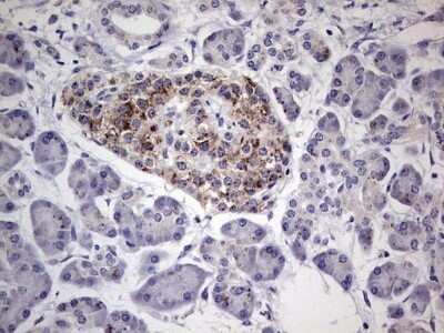 Immunohistochemistry: u-Plasminogen Activator/Urokinase Antibody (OTI5H4) - Azide and BSA Free [NBP2-74793] - Analysis of Carcinoma of Human pancreas tissue. (Heat-induced epitope retrieval by 1 mM EDTA in 10mM Tris, pH8.5, 120C for 3min)