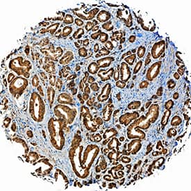 ADAM15 was detected in immersion fixed paraffin-embedded sections of human prostate using Goat Anti-Human ADAM15 Ectodomain Antigen Affinity-purified Polyclonal Antibody (Catalog # AF935) at 5 µg/mL overnight at 4 °C. Tissue was stained using the Anti-Goat HRP-DAB Cell & Tissue Staining Kit (brown; Catalog # CTS008) and counterstained with hematoxylin (blue). Specific staining was localized to cytoplasm in epithelial cells. View our protocol for Chromogenic IHC Staining of Paraffin-embedded Tissue Sections.