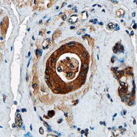 AG-3 was detected in immersion fixed paraffin-embedded sections of human breast using Sheep Anti-Human AG-3 Antigen Affinity-purified Polyclonal Antibody (Catalog # AF6307) at 3 µg/mL overnight at 4 °C. Tissue was stained using the Anti-Sheep HRP-DAB Cell & Tissue Staining Kit (brown; Catalog # CTS019) and counterstained with hematoxylin (blue). Specific staining was localized to epithelial cells. View our protocol for Chromogenic IHC Staining of Paraffin-embedded Tissue Sections.