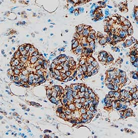 AG-2/AGR2 was detected in immersion fixed paraffin-embedded sections of human breast cancer tissue using Sheep Anti-Human AG-2/AGR2 Antigen Affinity-purified Polyclonal Antibody (Catalog # AF6068) at 10 µg/mL overnight at 4 °C. Tissue was stained using the Anti-Sheep HRP-DAB Cell & Tissue Staining Kit (brown; Catalog # CTS019) and counterstained with hematoxylin (blue). Specific staining was localized to plasma membrane in cancer cells. View our protocol for Chromogenic IHC Staining of Paraffin-embedded Tissue Sections.