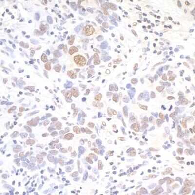 Immunohistochemistry-Paraffin: API5 Antibody [NBP1-46223] - Detection of human API5 by immunohistochemistry. Sample: FFPE section of human breast carcinoma. Antibody: Affinity purified rabbit anti-API5 (NBP1-46223). Detection: DAB