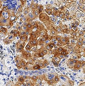     ASGR2  was detected in immersion fixed paraffin-embedded sections of human liver  using Rabbit Anti-Human ASGR2 Monoclonal Antibody (Catalog # MAB9970) at  1 µg/mL for 1 hour at room temperature followed by  incubation with the Anti-Rabbit IgG VisUCyte™ HRP Polymer Antibody  (Catalog # VC003).  Tissue was stained using DAB (brown) and counterstained with hematoxylin  (blue).  Specific staining was  localized to cytoplasm in hepatocytes. View our protocol for IHC  Staining with VisUCyte HRP Polymer Detection Reagents. 