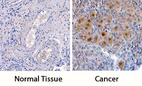 ATR was detected in immersion fixed paraffin-embedded sections of human ovarian cancer tissue using Goat Anti-Human ATR Antigen Affinity-purified Polyclonal Antibody (Catalog # AF4717) at 5 µg/mL overnight at 4 °C. Tissue was stained using the Anti-Goat HRP-DAB Cell & Tissue Staining Kit (brown; Catalog # CTS008) and counterstained with hematoxylin (blue). Specific staining was localized to nuclei in cancer cells. View our protocol for Chromogenic IHC Staining of Paraffin-embedded Tissue Sections.