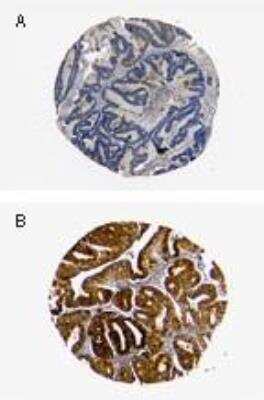 Immunohistochemistry-Paraffin: BID Antibody [NB100-56106] - Two cores from a human ovarian carcinoma formalin-fixed, paraffin-embedded tissue microarray demonstrate the variable expression of Bid protein.  The sections were stained with Bid antibody at 1:2000  with hematoxylin-eosin counterstain.  Section A shows very weak staining while section B stains much more strongly.