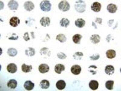 Immunohistochemistry-Paraffin: BID Antibody [NB100-56106] -  Formalin-fixed, paraffin-embedded human ovarian carcinoma tissue array stained for Bid expression using this antibody at 1:2000. Hematoxylin-eosin counterstain. Variable Bid expression is seen between patient samples.