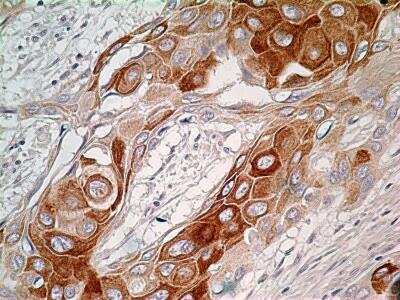 Immunohistochemistry-Paraffin: Bcl6 Antibody [NBP2-31369] - IHC analysis of formalin-fixed paraffin-embedded tissue section of human esophageal squamous cell carcinoma (SCC) using Bcl6 antibody at a concentration of 5 ug/ml. Nuclear as well as cytoplasmic immunoreactivity was observed for Bcl6 protein in SCC cells whereas the tumor stroma cells did not develop DAB staining. [40X Magnification]