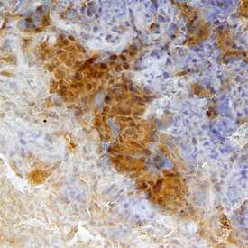 CEACAM-4 was detected in immersion fixed paraffin-embedded sections of human lung cancer tissue using Mouse Anti-Human CEACAM-4 Monoclonal Antibody (Catalog # MAB4354) at 15 µg/mL overnight at 4 °C. Before incubation with the primary antibody, tissue was subjected to heat-induced epitope retrieval using Antigen Retrieval Reagent-Basic (Catalog # CTS013). Tissue was stained using the Anti-Mouse HRP-DAB Cell & Tissue Staining Kit (brown; Catalog # CTS002) and counterstained with hematoxylin (blue). Specific staining was localized to the cytoplasm of epithelial cells. View our protocol for Chromogenic IHC Staining of Paraffin-embedded Tissue Sections.