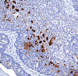     CEACAM‑7  was detected in immersion fixed paraffin-embedded sections of human colon  cancer tissue using Mouse Anti-Human CEACAM‑7 Monoclonal Antibody  (Catalog # MAB44781) at 5 µg/mL for 1 hour at room  temperature followed by incubation with the Anti-Mouse IgG  VisUCyte™  HRP Polymer  Antibody (Catalog # VC001).  Tissue was stained using DAB (brown) and counterstained with hematoxylin  (blue).  Specific staining was  localized to cytoplasm. View our protocol for IHC  Staining with VisUCyte HRP Polymer Detection Reagents. 