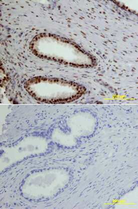 CREB was detected in immersion fixed paraffin-embedded sections of human spinal prostate array using Human CREB Monoclonal Antibody (Catalog # MAB2989) at 15 µg/mL overnight at 4 °C. Tissue was stained using the Anti-Mouse HRP-DAB Cell & Tissue Staining Kit (brown; Catalog # CTS002) and counterstained with hematoxylin (blue). View our protocol for Chromogenic IHC Staining of Paraffin-embedded Tissue Sections.