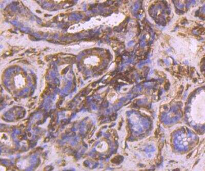 Immunohistochemistry-Paraffin: CRMP2 Antibody [NBP2-89138] - Analysis of paraffin-embedded human breast cancer tissue using anti-CRMP2 antibody. Counter stained with hematoxylin.