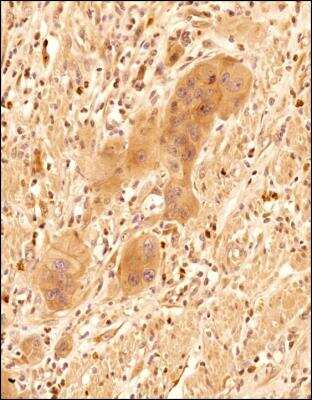 Immunohistochemistry-Paraffin: CXCL13/BLC/BCA-1 Antibody [NBP2-16041] - Analysis of a FFPE tissue section of human esophageal carcinoma using 1:300 dilution of CXCL13 antibody (NBP2-16041). The signal was developed using HRP-DAB method which followed counterstaining of the cells with hematoxylin.