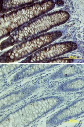 Cadherin-17 was detected in immersion fixed paraffin-embedded sections of human colon array using Goat Anti-Human Cadherin-17 Antigen Affinity-purified Polyclonal Antibody (Catalog # AF1032) at 15 µg/mL overnight at 4 °C. Tissue was stained using the Anti-Goat HRP-DAB Cell & Tissue Staining Kit (brown; Catalog # CTS008) and counterstained with hematoxylin (blue). Lower panel shows a lack of labeling if primary antibodies are omitted and tissue is stained only with secondary antibody followed by incubation with detection reagents. View our protocol for Chromogenic IHC Staining of Paraffin-embedded Tissue Sections.