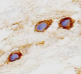 Cadherin-6/KCAD was detected in immersion fixed paraffin-embedded sections of human kidney cancer tissue using 25 µg/mL Mouse Anti-Human Cadherin-6/KCAD Monoclonal Antibody (Catalog # MAB27151) overnight at 4 °C. Tissue was stained with the Anti-Mouse HRP-DAB Cell & Tissue Staining Kit (brown; Catalog # CTS002) and counterstained with hematoxylin (blue). View our protocol for Chromogenic IHC Staining of Paraffin-embedded Tissue Sections.