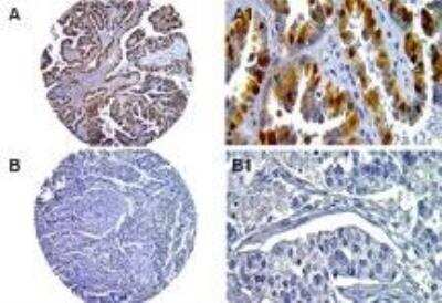 Immunohistochemistry-Paraffin: Caspase-14 Antibody [NB100-56126] - Human ovarian cancer tissue microarray stained for Caspase-14 expression using this antibody at 1:2000. Low (A) and high (B) stage ovarian tumor tissue cores. High magnification from areas of the tissue cores (A1 and B1). Decreased Caspase-14 expression was seen in the high grade, compared to the low grade tumor. Hematoxylin-eosin counterstain.