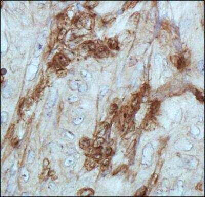 Immunohistochemistry: Cathepsin E Antibody [NB400-152] - Analysis of Cathepsin E in human renal cancer using DAB with hematoxylin counterstain.
