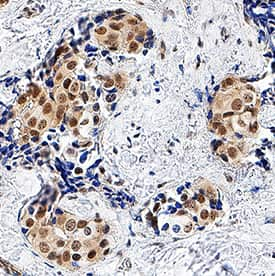 Cited-2 was detected in immersion fixed paraffin-embedded sections of human breast cancer tissue using Sheep Anti-Human/Mouse Cited-2 Antigen Affinity-purified Polyclonal Antibody (Catalog # AF5005) at 3 µg/mL overnight at 4 °C. Tissue was stained using the Anti-Sheep HRP-DAB Cell & Tissue Staining Kit (brown; Catalog # CTS019) and counterstained with hematoxylin (blue). Specific staining was localized to nuclei. View our protocol for Chromogenic IHC Staining of Paraffin-embedded Tissue Sections.