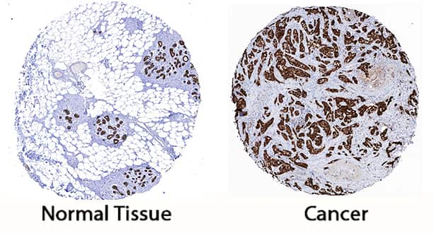         Cytokeratin 19  was detected in immersion fixed paraffin-embedded sections of human breast  cancer tissue using Mouse Anti-Human Cytokeratin 19 Monoclonal  Antibody (Catalog # MAB35061) at 5 µg/mL for 1 hour at  room temperature followed by incubation with the Anti-Mouse IgG  VisUCyte™  HRP Polymer  Antibody (Catalog # VC001).  Tissue was stained using DAB (brown) and counterstained with hematoxylin  (blue).  Specific staining was  localized to cytoplasm. View our protocol for IHC  Staining with VisUCyte HRP Polymer Detection Reagents.  