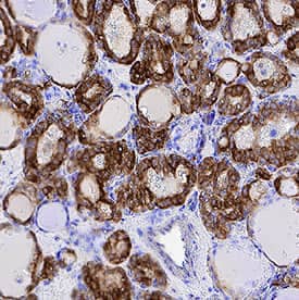     Cytokeratin 19  was detected in immersion fixed paraffin-embedded sections of human papillary  thyroid cancer tissue using Mouse Anti-Human Cytokeratin 19  Monoclonal Antibody (Catalog # MAB35061) at 0.5 µg/mL for  1 hour at room temperature followed by incubation with the Anti-Mouse IgG  VisUCyte™  HRP Polymer  Antibody (Catalog # VC001).  Tissue was stained using DAB (brown) and counterstained with hematoxylin  (blue).  Specific staining was  localized to cytoplasm in epithelial cells. View our protocol for IHC  Staining with VisUCyte HRP Polymer Detection Reagents. 