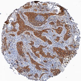   DPP3  was detected in immersion fixed paraffin-embedded sections of human squamous  cell carcinoma using Rat Anti-Human DPP3 Monoclonal Antibody (Catalog #  MAB80872) at 5 µg/mL for 1 hour at room temperature  followed by incubation with the Anti-Rat IgG VisUCyte™ HRP Polymer  Antibody (Catalog # VC005).  Before incubation with the primary antibody, tissue was subjected to  heat-induced epitope retrieval using Antigen Retrieval Reagent-Basic (Catalog  # CTS013).  Tissue was stained using DAB (brown) and counterstained with hematoxylin  (blue). Specific staining was localized to cytoplasm. View our protocol for  IHC  Staining with VisUCyte HRP Polymer Detection Reagents.