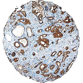PKM2 was detected in immersion fixed paraffin-embedded sections of human prostate cancer tissue using Sheep Anti-Human/Mouse/Rat PKM2 Antigen Affinity-purified Polyclonal Antibody (Catalog # AF7244) conjugated to Digoxigenin at 10 µg/mL overnight at 4 °C, followed by Mouse Anti-Digoxigenin Recombinant Monoclonal Antibody (Catalog # MAB7520R) at 5 µg/mL for 1 hour at room temperature. Tissue was stained using the Anti-Mouse HRP-DAB Cell & Tissue Staining Kit (brown; Catalog # CTS002) and counterstained with hematoxylin (blue). Specific staining was localized to epithelial cells. View our protocol for Chromogenic IHC Staining of Paraffin-embedded Tissue Sections.