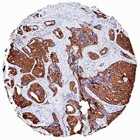        EMAP‑II  was detected in immersion fixed paraffin-embedded sections of human prostate  cancer tissue using Mouse Anti-Human/Mouse/Rat EMAP‑II Monoclonal  Antibody (Catalog # MAB1910) at 5 µg/mL for 1 hour at room  temperature followed by incubation with the Anti-Mouse IgG  VisUCyte™  HRP Polymer  Antibody (Catalog # VC001).  Tissue was stained using DAB (brown) and counterstained with hematoxylin  (blue).  Specific staining was  localized to cancer cells. View our protocol for IHC  Staining with VisUCyte HRP Polymer Detection Reagents.  