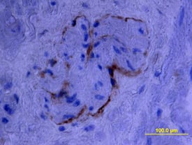 Endoglin/CD105 was detected in immersion fixed paraffin-embedded sections of human prostate using Goat Anti-Human Endoglin/CD105 Biotinylated Antigen Affinity-purified Polyclonal Antibody (Catalog # BAF1097) at 15 µg/mL overnight at 4 °C. Tissue was stained using the Anti-Goat HRP-DAB Cell & Tissue Staining Kit (brown; Catalog # CTS008) and counterstained with hematoxylin (blue). View our protocol for Chromogenic IHC Staining of Paraffin-embedded Tissue Sections.