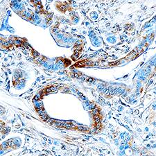 Endophilin B1/Bif-1 was detected in immersion fixed paraffin-embedded sections of human pancreatic cancer tissue using Sheep Anti-Human Endophilin B1/Bif-1 Antigen Affinity-purified Polyclonal Antibody (Catalog # AF7456) at 3 µg/mL overnight at 4 °C. Tissue was stained using the Anti-Sheep HRP-DAB Cell & Tissue Staining Kit (brown; Catalog # CTS019) and counterstained with hematoxylin (blue). Specific staining was localized to cytoplasm in epithelial cells. View our protocol for Chromogenic IHC Staining of Paraffin-embedded Tissue Sections.