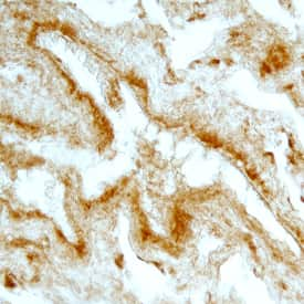 FGF-5 was detected in immersion fixed paraffin-embedded sections of human breast cancer tissue using Mouse Anti-Human FGF-5 Monoclonal Antibody (Catalog # MAB2371) at 25 µg/mL overnight at 4 °C. Tissue was stained using the Anti-Mouse HRP-DAB Cell & Tissue Staining Kit (brown; Catalog # CTS002) and counterstained with hematoxylin (blue). Specific staining was localized to plasma membrane of ductal cells. View our protocol for Chromogenic IHC Staining of Paraffin-embedded Tissue Sections.