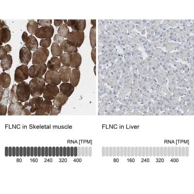 FLNC-Associated Myofibrillar Myopathy