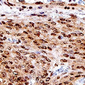   FOXL2  was detected in immersion fixed paraffin-embedded sections of ovarian cancer  tissue using Mouse Anti-Human FOXL2 Monoclonal Antibody (Catalog # MAB10396)  at 5 µg/mL for 1 hour at room temperature followed by  incubation with the Anti-Mouse IgG VisUCyte™ HRP Polymer Antibody  (Catalog # VC001).  Before incubation with the primary antibody, tissue was subjected to  heat-induced epitope retrieval using Antigen Retrieval Reagent-Basic (Catalog  # CTS013).  Tissue was stained using DAB (brown) and counterstained with hematoxylin  (blue). Specific staining was localized to cell nuclei. View our protocol for  IHC  Staining with VisUCyte HRP Polymer Detection Reagents.