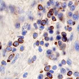 Frizzled-6 was detected in immersion fixed paraffin-embedded sections of human kidney cancer tissue using Goat Anti-Human Frizzled-6 Antigen Affinity-purified Polyclonal Antibody (Catalog # AF3149) at 10 µg/mL overnight at 4 °C. Before incubation with the primary antibody, tissue was subjected to heat-induced epitope retrieval using Antigen Retrieval Reagent-Basic (Catalog # CTS013). Tissue was stained using the Anti-Goat HRP-DAB Cell & Tissue Staining Kit (brown; (CTS008) and counterstained with hematoxylin (blue). Specific staining was localized to cell membranes. View our protocol for Chromogenic IHC Staining of Paraffin-embedded Tissue Sections.