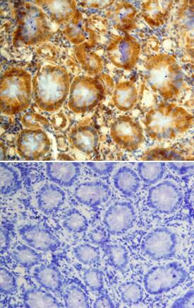 GDF‑11/BMP‑11 was detected in immersion fixed paraffin-embedded sections of human colon cancer tissue using Mouse Anti-Human GDF‑11/BMP‑11 Monoclonal Antibody (Catalog # MAB19581) at 15 µg/mL overnight at 4 °C. Tissue was stained using the Anti-Mouse HRP-DAB Cell & Tissue Staining Kit (brown; Catalog # CTS002) and counterstained with hematoxylin (blue). Lower panel shows a lack of labeling when primary antibodies are omitted and tissue is stained only with secondary antibody followed by incubation with detection reagents. Specific staining was localized to epithelia of the colon. View our protocol for Chromogenic IHC Staining of Paraffin-embedded Tissue Sections. 