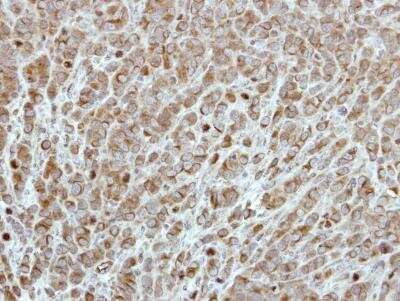 Immunohistochemistry-Paraffin: Glucokinase/GCK Antibody [NBP1-33144] - MCF7 xenograft, using Glucokinase  antibody at 1:500 dilution. Antigen Retrieval: Trilogy&amp;#8482; (EDTA based, pH 8.0) buffer, 15min.