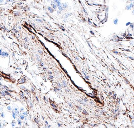   Glypican 1  was detected in immersion fixed paraffin-embedded sections of human placenta  using Mouse Anti-Human/Mouse/Rat Glypican 1 Monoclonal Antibody (Catalog #  MAB45191) at 5 µg/mL for 1 hour at room temperature  followed by incubation with the Anti-Mouse IgG VisUCyte™ HRP  Polymer Antibody (Catalog # VC001).  Before incubation with the primary antibody, tissue was subjected to  heat-induced epitope retrieval using Antigen Retrieval Reagent-Basic (Catalog  # CTS013).  Tissue was stained using DAB (brown) and counterstained with hematoxylin  (blue). Specific staining was localized to endothelial cells. View our  protocol for IHC  Staining with VisUCyte HRP Polymer Detection Reagents.