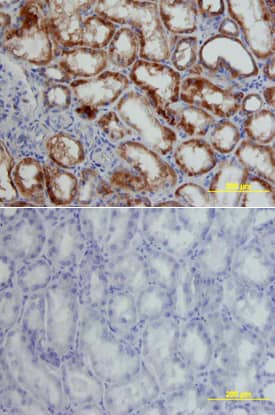 HIF-1 alpha/HIF1A was detected in immersion fixed paraffin-embedded sections of human kidney cancer tissue using Mouse Anti-Human/Mouse HIF-1 alpha/HIF1A Monoclonal Antibody (Catalog # MAB1935) at 15 µg/mL overnight at 4 °C. Tissue was stained using the Anti-Mouse HRP-DAB Cell & Tissue Staining Kit (brown; Catalog # CTS002) and counterstained with hematoxylin (blue). Lower panel shows a lack of labeling if primary antibodies are omitted and tissue is stained only with secondary antibody followed by incubation with detection reagents. View our protocol for Chromogenic IHC Staining of Paraffin-embedded Tissue Sections.