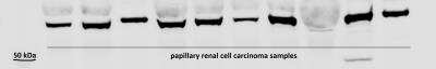 Western Blot: HIF-3 alpha Antibody [NB100-2529] - HIF-3a expression in papillary renal cell carcinoma samples. Image from verified customer review.