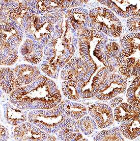 HSP27 was detected in immersion fixed paraffin-embedded sections of human ovarian cancer tissue using Rat Anti-Human HSP27 Monoclonal Antibody (Catalog # MAB15801) at 5 µg/mL overnight at 4 °C. Tissue was stained using the Anti-Rat HRP-DAB Cell & Tissue Staining Kit (brown; Catalog # CTS017) and counterstained with hematoxylin (blue). Specific staining was localized to cytoplasm and plasma membrane in epithelial cells. View our protocol for Chromogenic IHC Staining of Paraffin-embedded Tissue Sections.