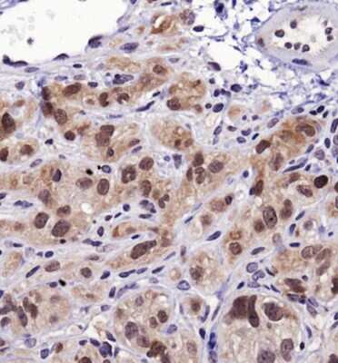 Immunohistochemistry: HSP70/HSPA1A Antibody [NBP1-77456] - Analysis of Hsp70 in human xenograft kidney cancer using DAB with hematoxylin counterstain.