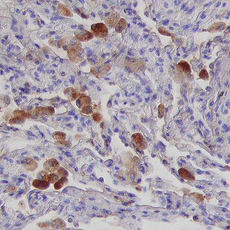     Herpesvirus  Entry Mediator (HVEM/TNFRSF14) was detected in immersion fixed  paraffin-embedded sections of human lung using Mouse Anti-Human HVEM/TNFRSF14  Monoclonal Antibody (Catalog # MAB3561)  at 15 µg/mL for 1 hour at room temperature followed by  incubation with the Anti-Mouse IgG VisUCyte™  HRP Polymer Antibody (Catalog #  VC001).  Tissue was stained using DAB (brown) and counterstained with hematoxylin  (blue). Specific staining was localized to cytoplasm. View our protocol for  IHC  Staining with VisUCyte HRP Polymer Detection Reagents. 